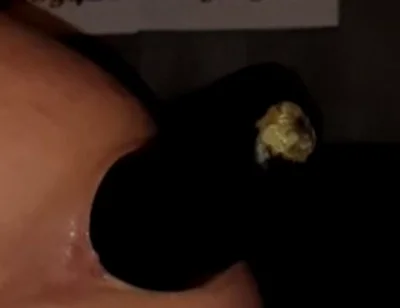 2 Huge Anal Eggplants Insertion ..big Anal Stretching!!