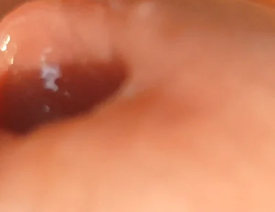 The Great Transformation of Phimosis Elastica.