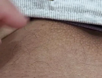 The Hair on My Penis - Led Hair Removal