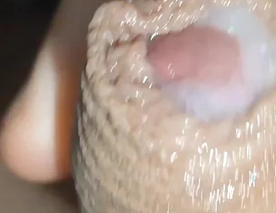 I Have the Largest Ejaculating Phimosis in the World!!