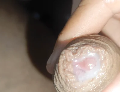 I Have the Largest Ejaculating Phimosis in the World!!