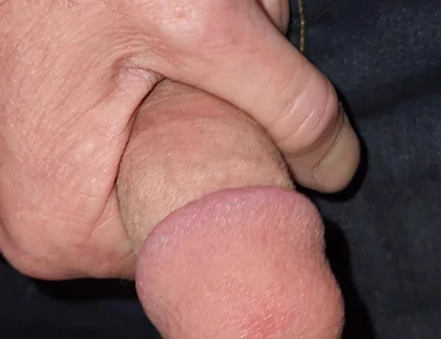 Gaping Urethra - Marker and Pinky Insertion