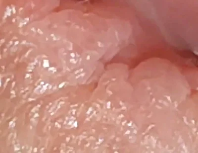 Enlargement of the Deep Urethral Hole!!