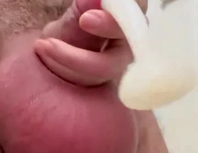 Inflated Ball Sack with Saline