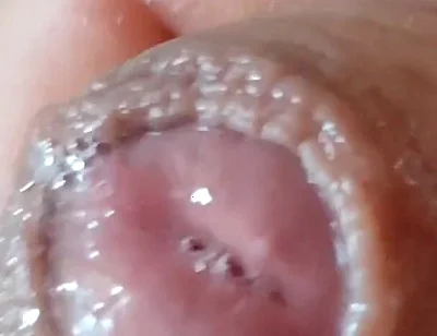 Deep Split in the Glans Produces Bubbling Liquid