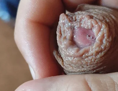 Deep Split in the Glans Produces Bubbling Liquid