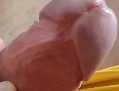 Scarred Frenulum Causes Glans Erection!