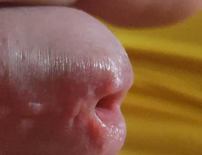 Scarred Frenulum Causes Glans Erection!