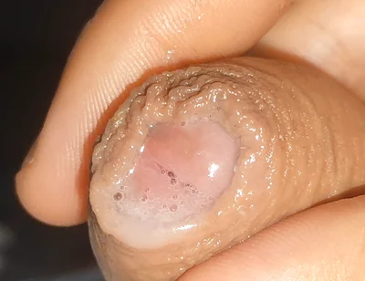 Curious Close-up of Pre-cum in Flaccid Phimosis.
