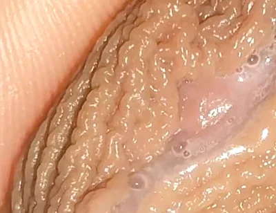Curious Close-up of Pre-cum in Flaccid Phimosis.