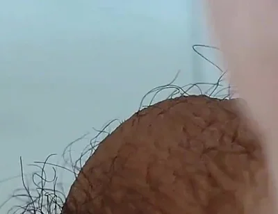 Extreme Open Hole Leaves the Glans Exposed.