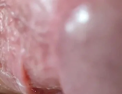 Opening the Scar of the Rough Frenulum!