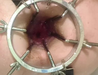 Enema, Anal Shower. Close-up View Through Anal Mirror. Anal with Water. Filling Anal with Water