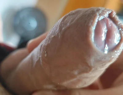 The Glans Appears Crowning Inside the Phimosis.