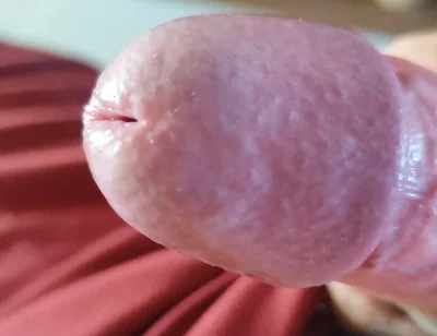 The Blossoming of Extensive Elastic Phimosis.