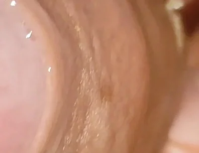 Large Cheese Accumulated in Close up of Glans