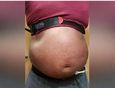N2o Belly Inflation