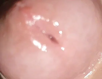 Maximum Dilation of Phimosis Cumming.
