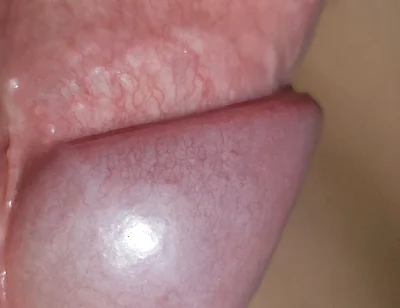 Amazing Upright Rough Venous Frenulum
