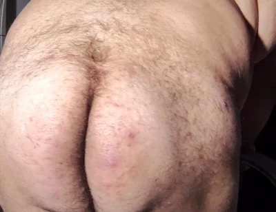 Fat Obese Butt