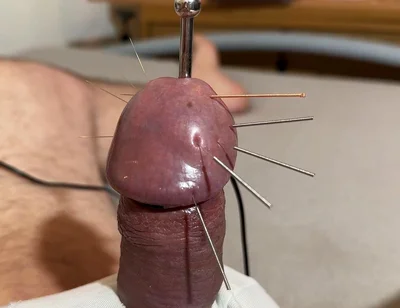 The Best Acupuncture Method!