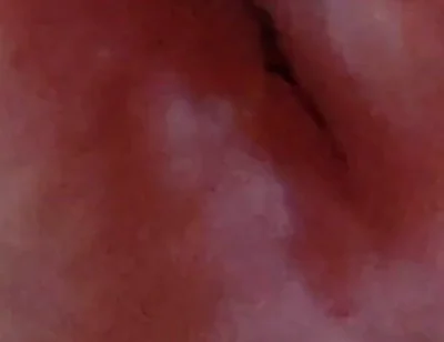Dilation of the Glans Eye Has a Pleasant Surprise.