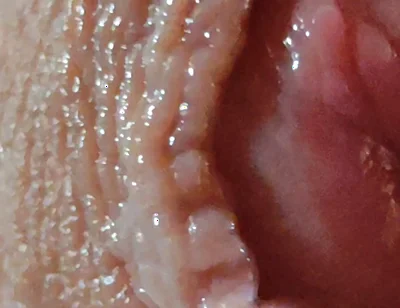 Dilation of the Glans Eye Has a Pleasant Surprise.