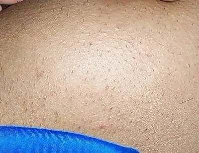 Hemorrhoids in the Ass