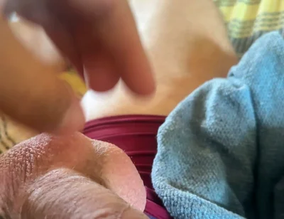 Extreme Venous Phimosis in the Pump!