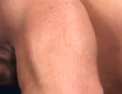 Rugburn