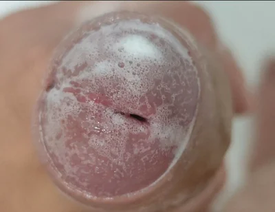 Extreme Burning Sensation Makes the Glans Foam with Arousal.