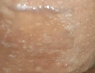 Scrotal Phimosis Results in an Extremely Hot Orgasm.