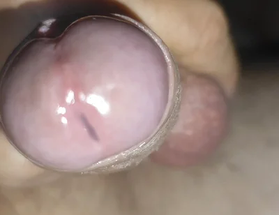 Scrotal Phimosis Results in an Extremely Hot Orgasm.