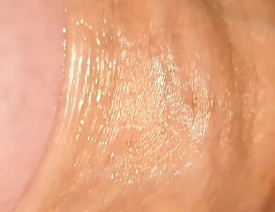 Difficult Fluid Control Due to Straight Phimosis.