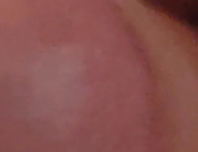 Immense Phimosis Being Extracted Cum and Précum.